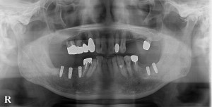 下顎両側にインプラントを埋入し義歯を入れずに済んだ症例